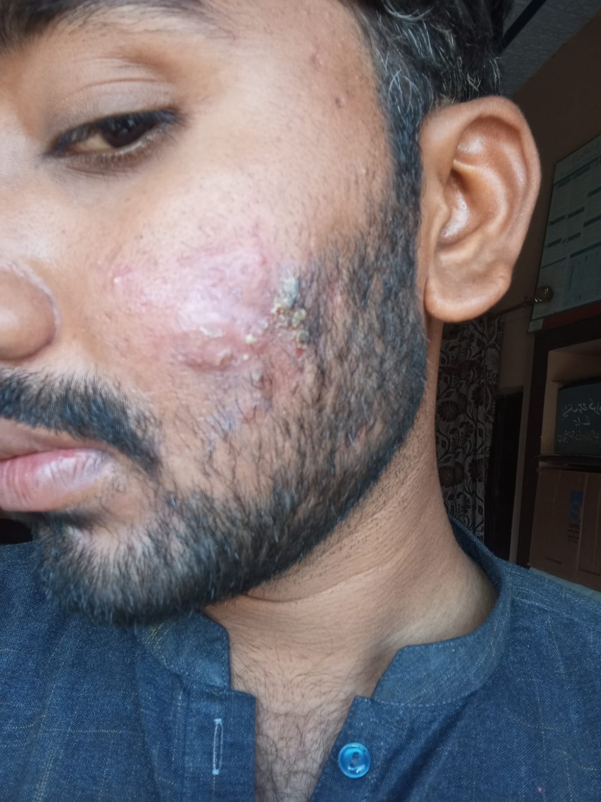 Before - skin